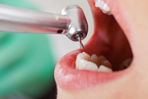 Best Emergency Root Canal Treatment in Lake Wilderness, VA